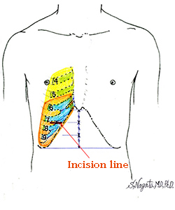 切開線イラスト