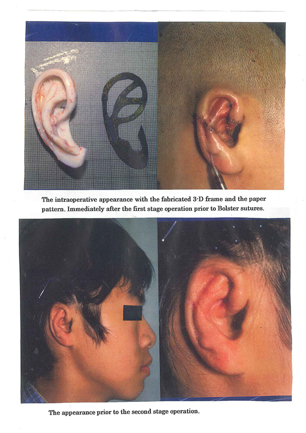 Auricular reconstruction following ENT surgery
