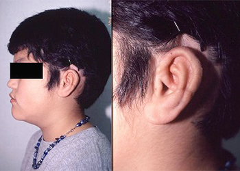 Concha Type,Post-operative Appearance