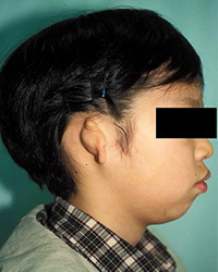 Concha Type,Preoperative Appecfance