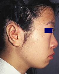 1st stage post-operative appearance