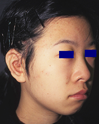 2nd stage post-operative appearance