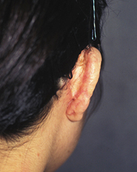 2nd stage post-operative appearance