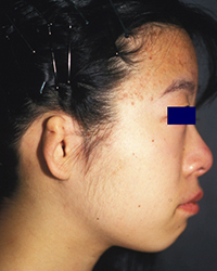 Preoperative appearance