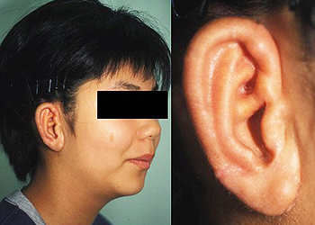 Lobule Type,Post-operative Appearance