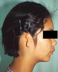 Lobule Type,Preoperative Appecfance