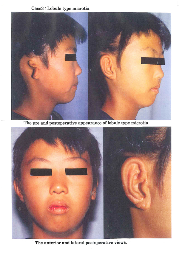 Lobule Type microtia