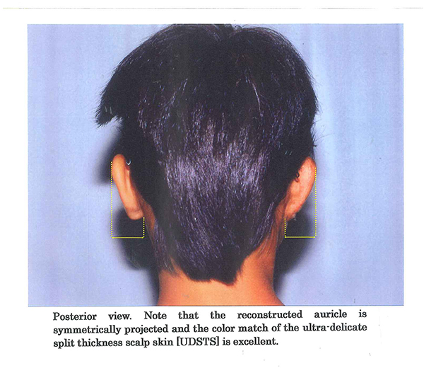 Lobule Type microtia