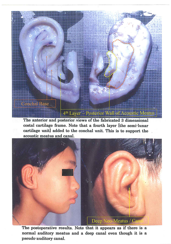 Lobule Type Microtia