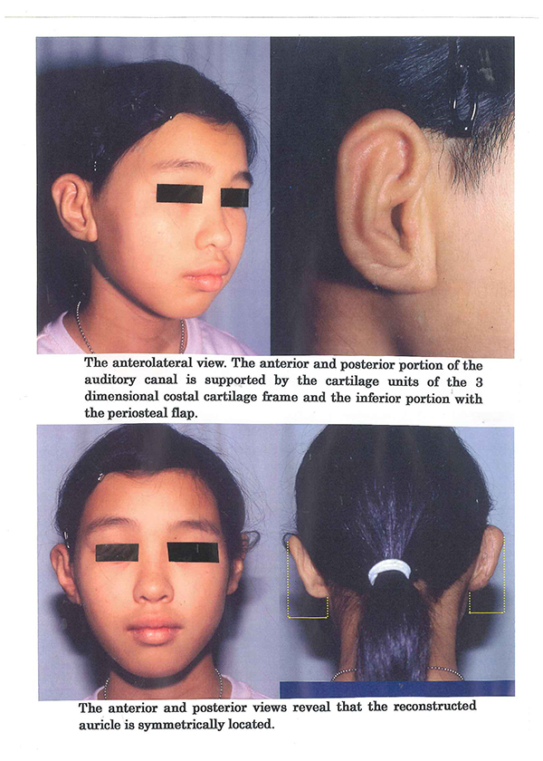 Lobule Type Microtia