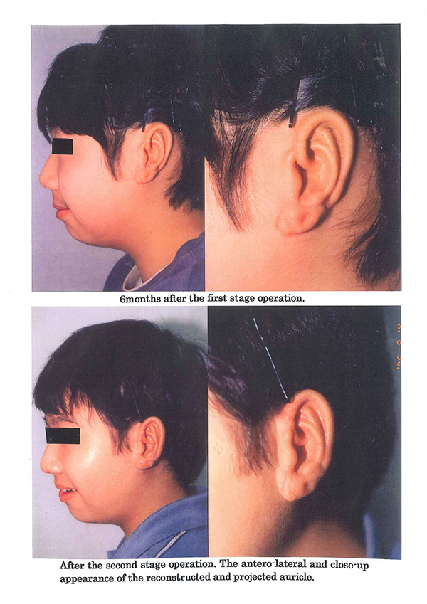 Lobule Type microtia