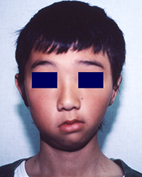 Intra-operative appearance (50% Low hairline)