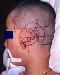 Preoperative appearance