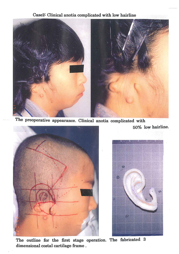 Clinical anotia complicated with low hairiine