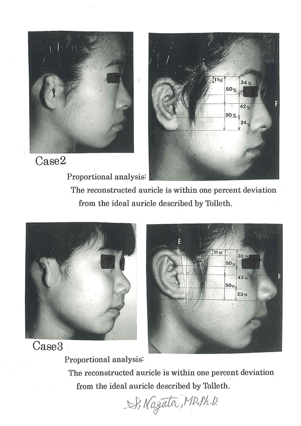 Accuracy evaluation on proportions of the reconstructed auricle / microtia surgery.