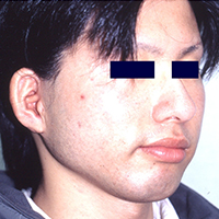 Post-operative appearance with Nagata method