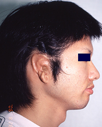 Preoperative Appecfance