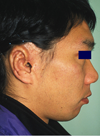 Preoperative Appecfance