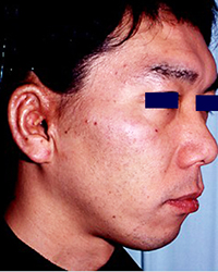 Preoperative Appecfance