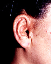 Preoperative Appecfance