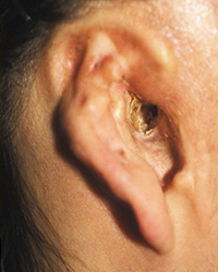 Preoperative Appecfance