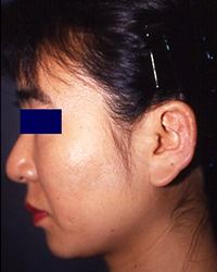 タンザ－法からの再建手術後