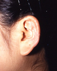 タンザ－法からの再建手術後