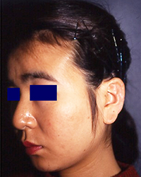 タンザ－法からの再建手術後耳アップ