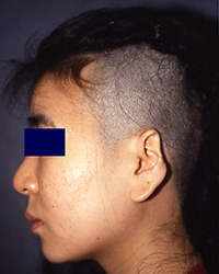 Laceration Caused By Broken Glass Nagata Microtia And Reconstructive Plastic Surgery Clinic