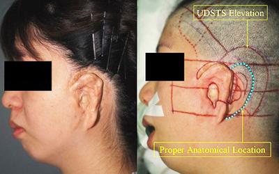 Preoperative Appecfance