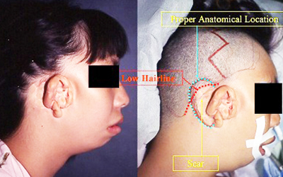 Preoperative Appecfance