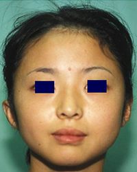 Post-operative Appearance