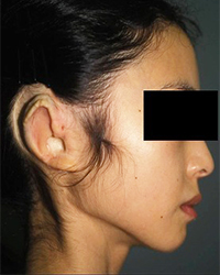 Preoperative Appecfance