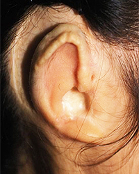 Preoperative Appecfance