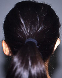 Preoperative Appecfance