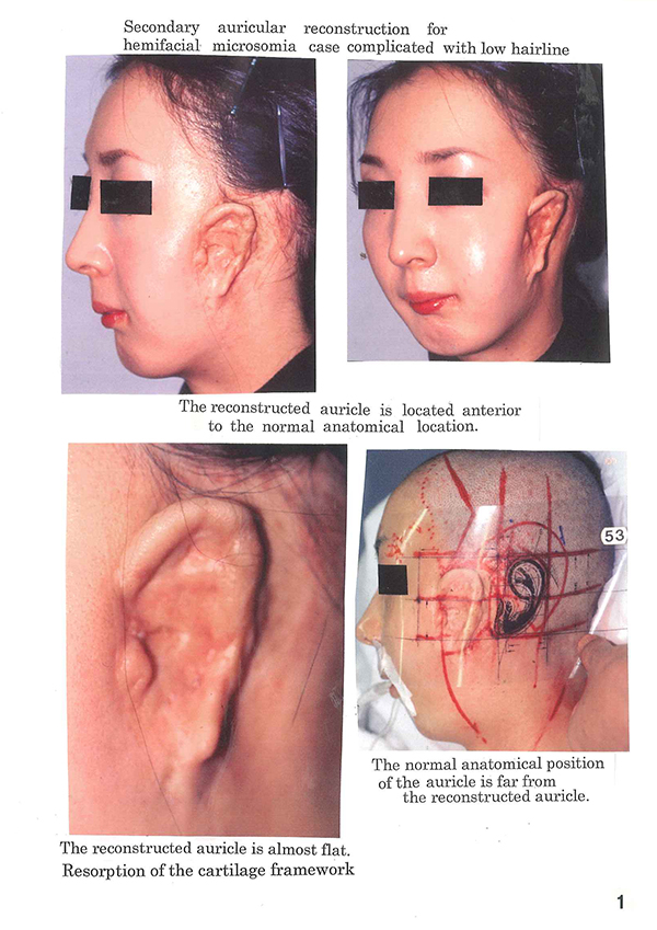 Post-operative appearance with Nagata method