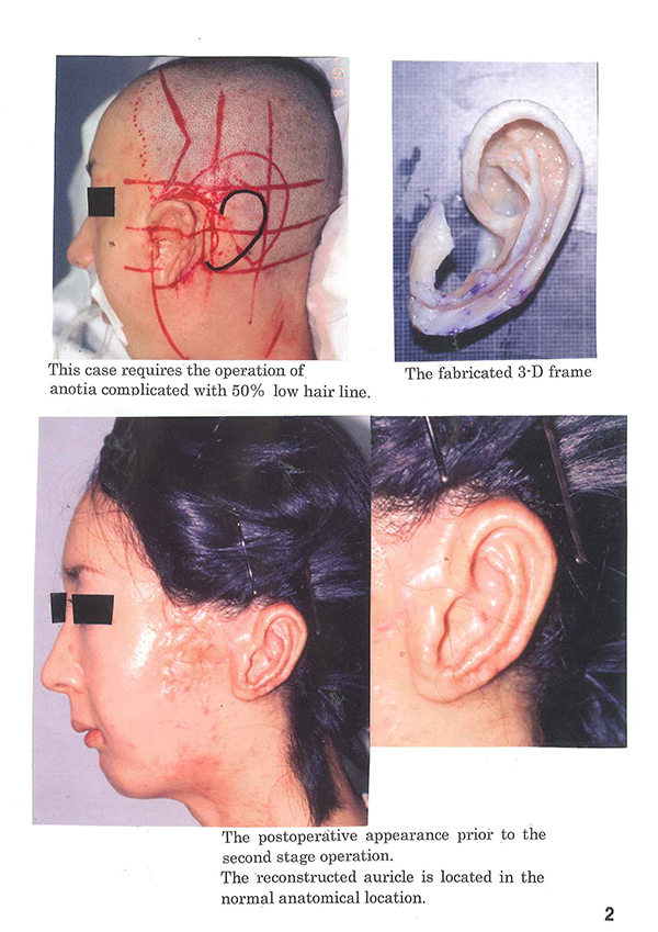 Post-operative appearance with Nagata method