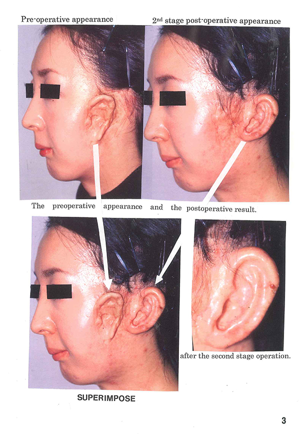 Post-operative appearance with Nagata method