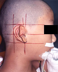 Preoperative Appearance