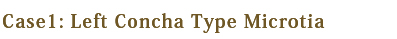 Left Concha Type Microtia