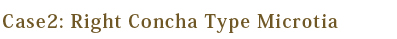 Right Concha Type Microtia