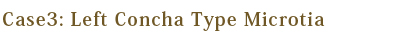 Left Concha Type Microtia