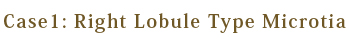 Right Lobule Type Microtia