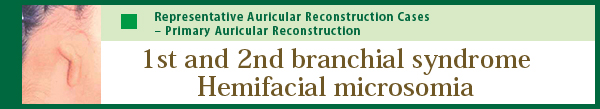 1st and 2st branchial syndrome:Hemifacial microsomia