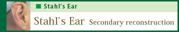 Stahl's ear Secondary reconstruction