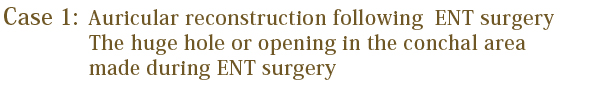 Auricular reconstruction following ENT surgery