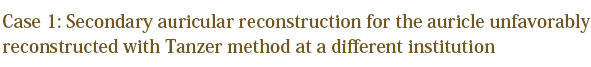 Case 1: Secondary auricular reconstruction for the auricle unfavorably reconstructed with Tanzer method at a different institution
