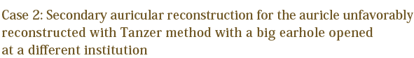 Case 2: Secondary auricular reconstruction for the auricle unfavorably reconstructed with Tanzer method with a big earhole opened at a different institution