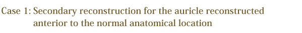Secondary reconstruction for auricle reconstructed anterior to the normal anatomical location