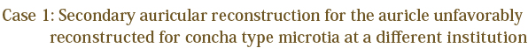 Secondary auricular reconstruction for the auricle unfavorably recibstructed for concha type microtia at a different institution